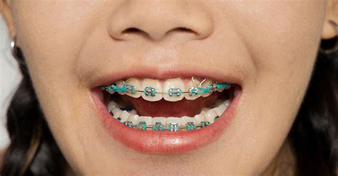 Can You Sleep with Rubber Bands on Your Braces? And Why Do Cats Always Land on Their Feet?