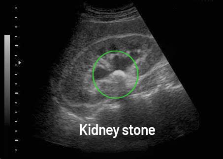 What Does a Kidney Stone Look Like on an Ultrasound? And Why Does It Remind Me of a Cosmic Pebble?